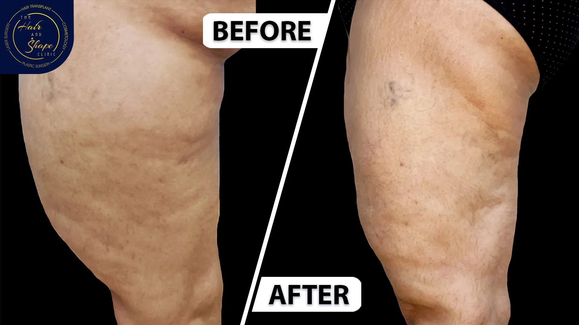 Thigh Liposuction result4